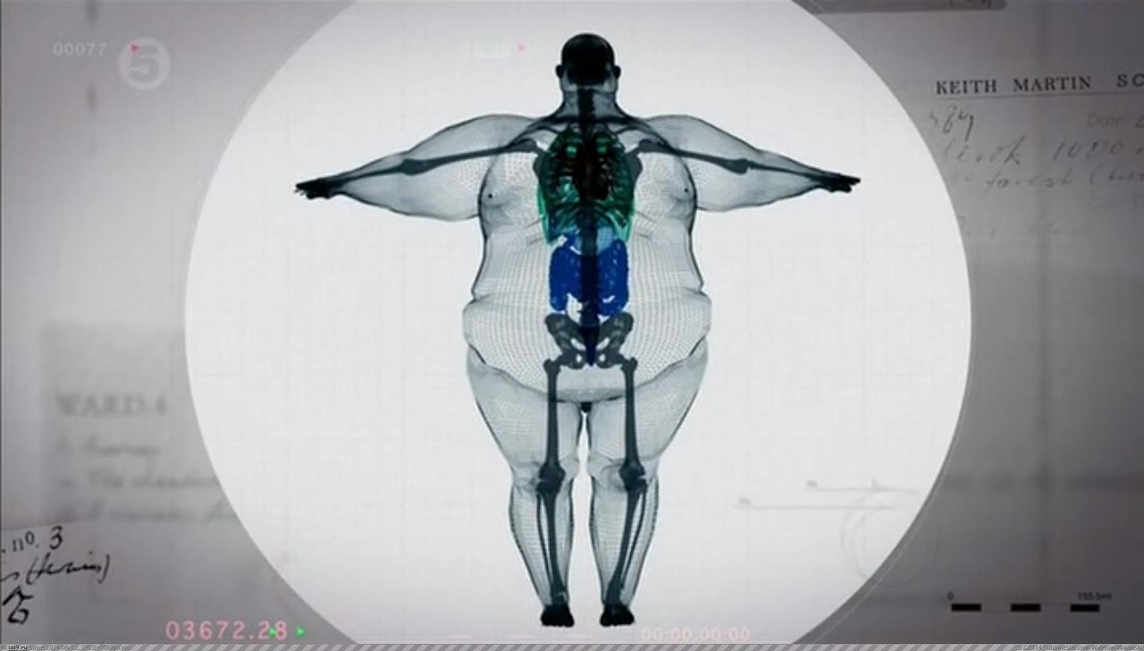 Скелет Толстого человека рентген