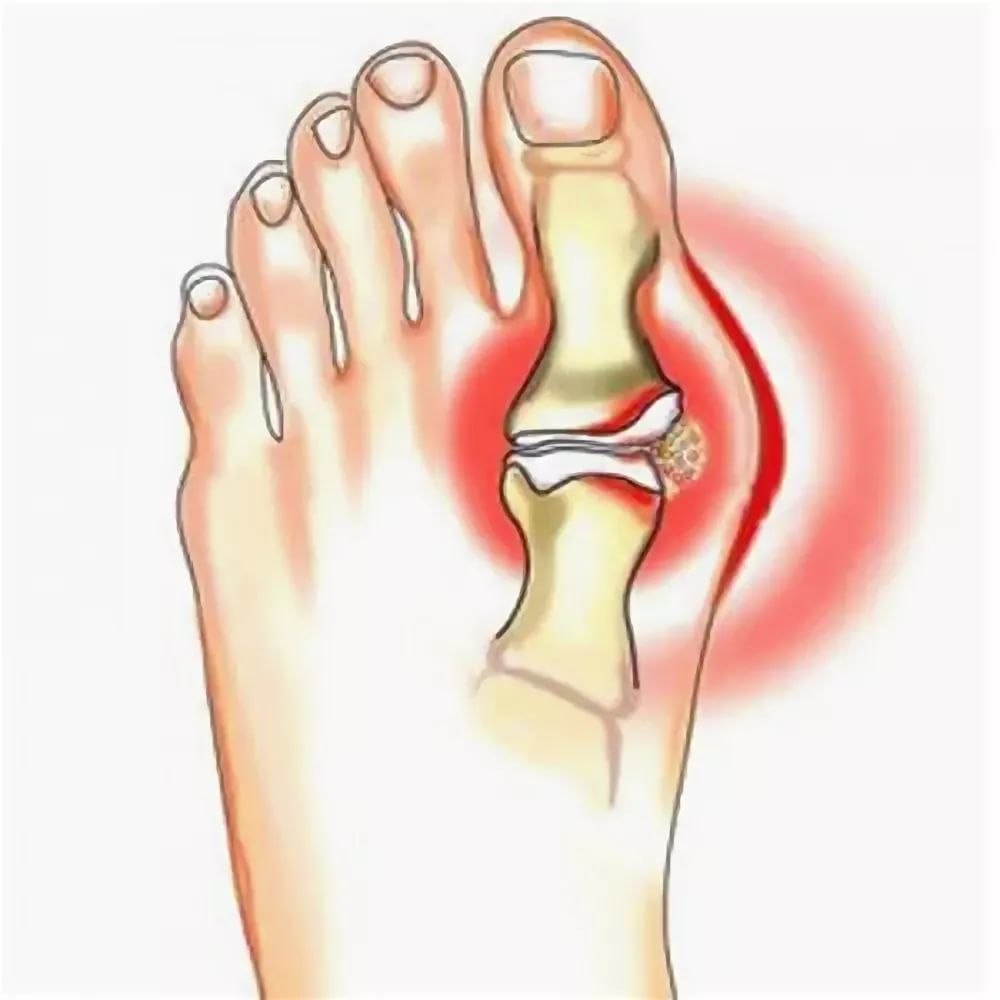 Подагра воспаление суставов
