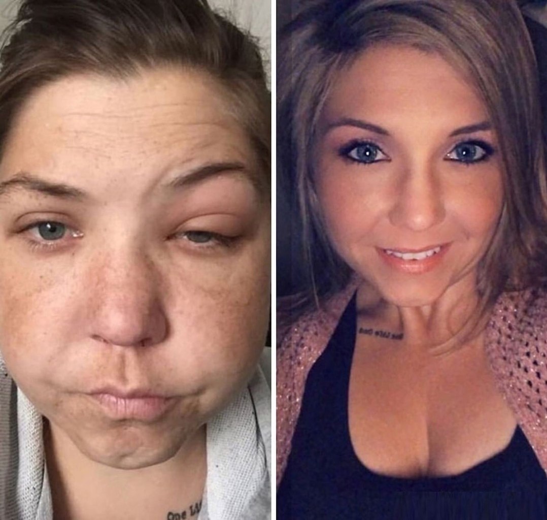 Пропитое лицо до и после