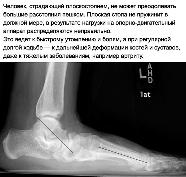 Плоскостопие рентген. Плосковальгусная стопа рентген. Плоскостопие на рентгенограмме. Рентген снимок плоскостопия. Рентген голеностопного сустава с плоскостопием.