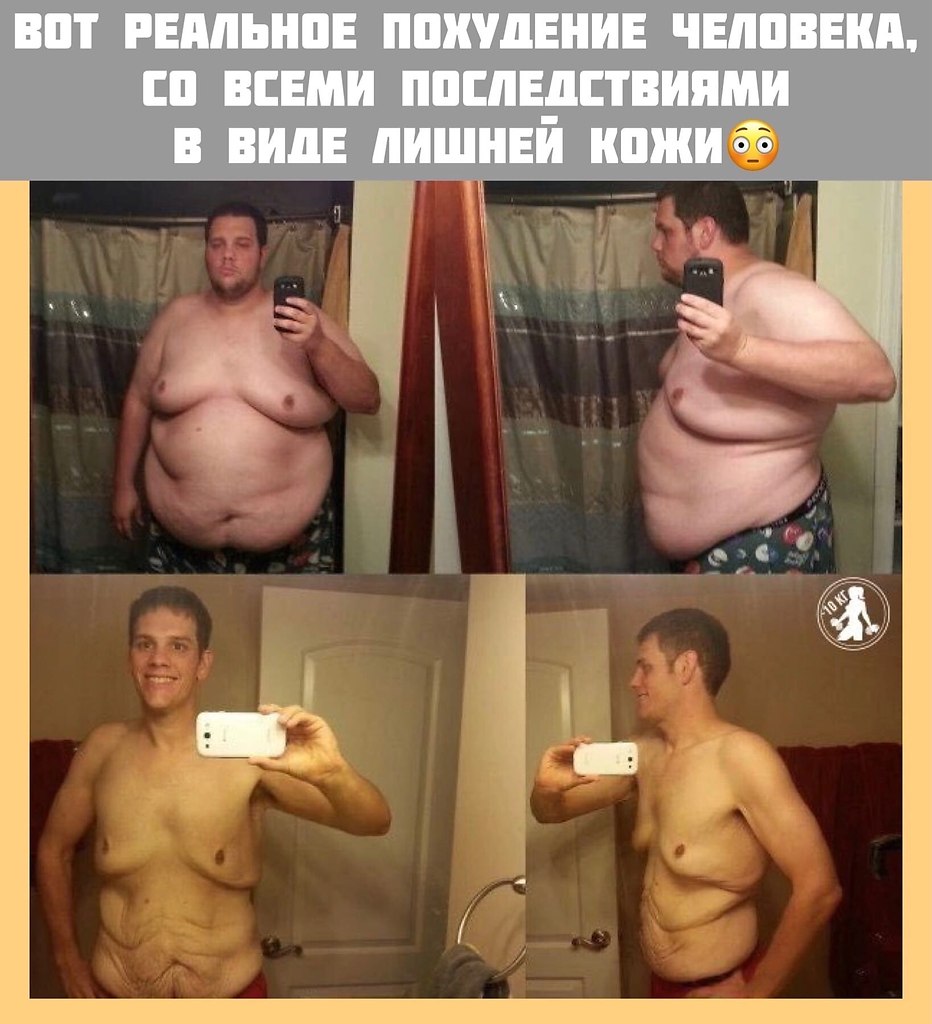 Скинешь потом фотки. Обвисяший кожа после похудения. Лишняя кожа после похудения. ОТВИСЛА кожа после похудения. Люди с обвисшей кожей после похудения.