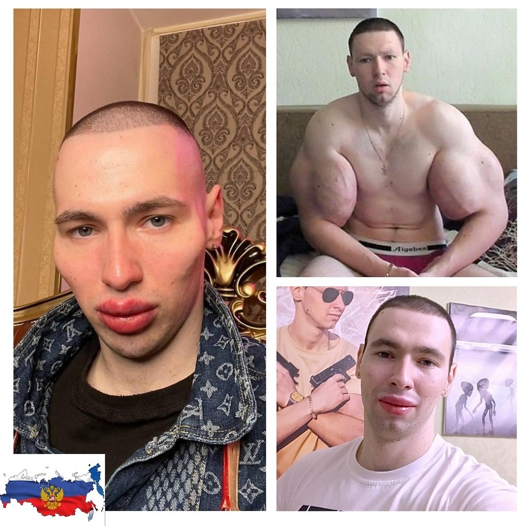 Кирилл Терешин накачал губы