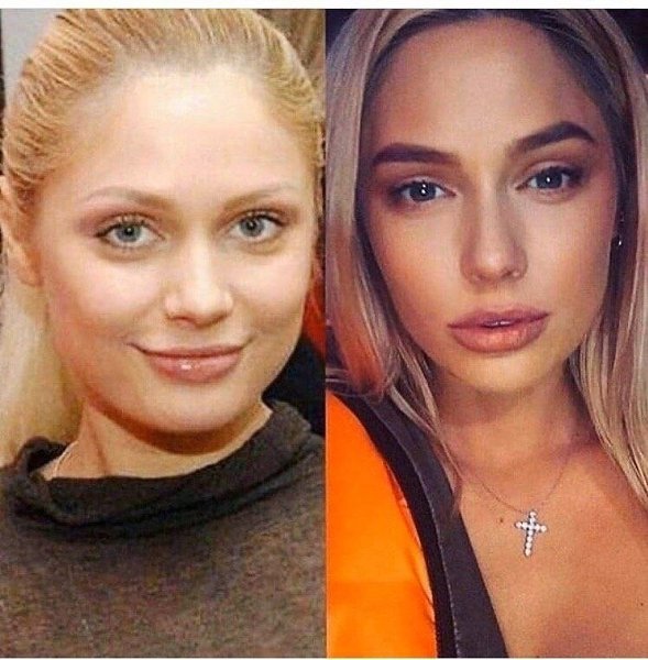 Рудова до и после пластики фото