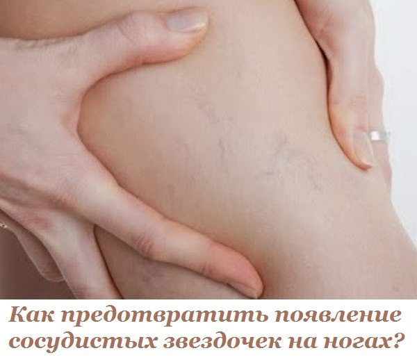 Как предотвратить появление сосудистых звездочек на ногах? Ох уж эти звездочки на ногах! Головная ...