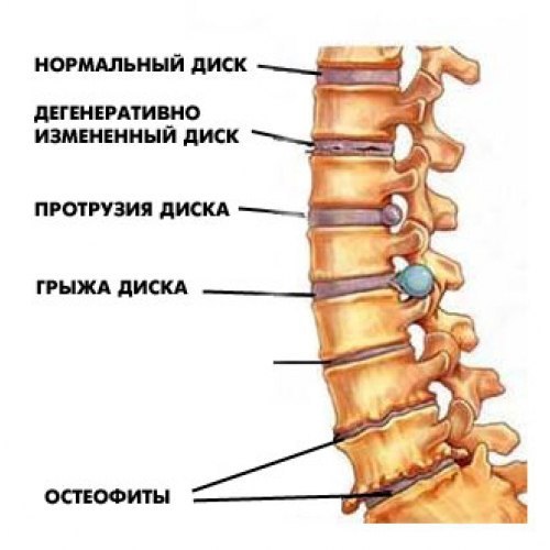Настои, мази от остеохондроза.Лечение остеохондроза и других болезней суставов травой морозника ...