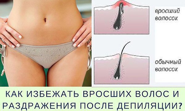 Девочки! Хочу рассказать вам секрет, как я поборола свою «растительность». Забудьте о бритье и ...