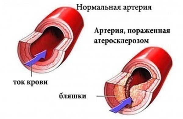УКРОП + МЁД + ВАЛЕРИАНА = ЧИСТЫЕ СОСУДЫ.Для этого приготовить вот такой настой: 1 стакан укропного ...