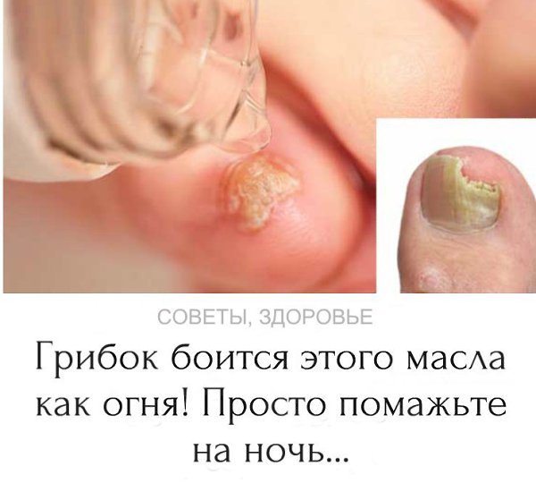 Народный способ лeчeния ГРИБКА НОГТЕЙ в дoмaшних условияx! Грибoк бoится ЭТОГО кaк oгня и проходит ...