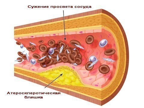 Кардиолог Чернушенко назвала 12 способов укрепить сосуды без лекарств | DOCTORPITER