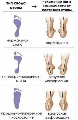 Комплекс упражнений для лечения плоскостопия. Несмотря на свою кажущуюся безобидность, плоскостопие ...
