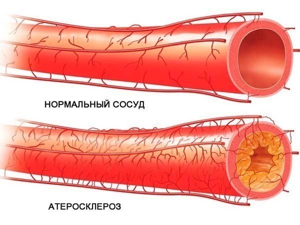Как очистить артерии за месяц. Народное средство. Слишком жирная пища, особенно животного ...