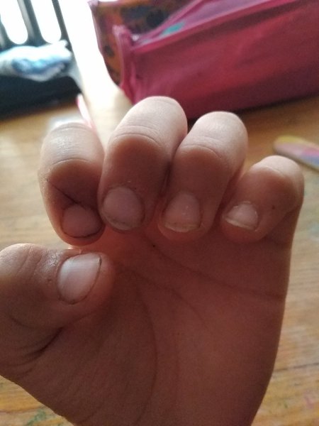 #Истории@modnailru. Что делать если на одной руке ногти растут, а на другой нет, и всё время когда я ...