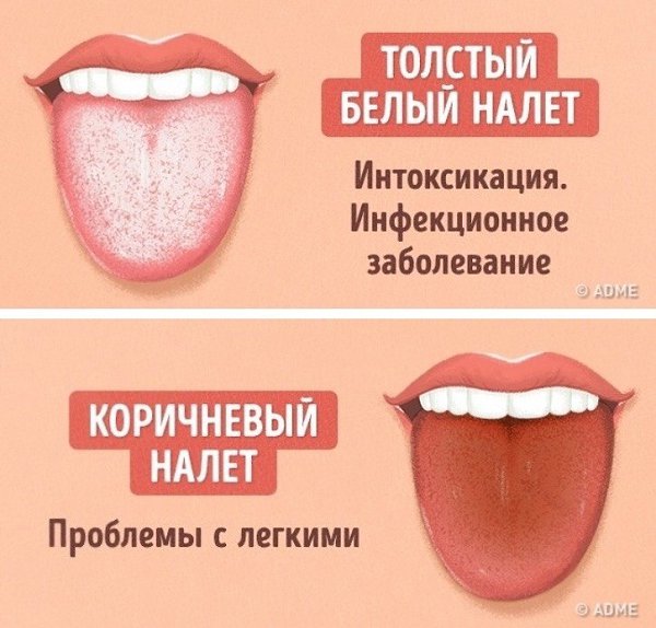 Как выявить проблемы со здоровьем по цвету языка: - 4