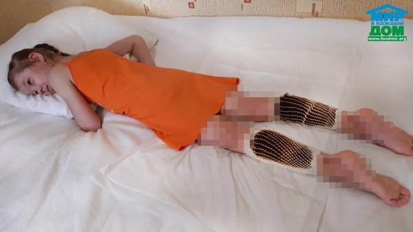 Катя Ю., 8 лет.Катя получила тяжелые ожоги вследствие несчастного случая: девочке на ножки ...