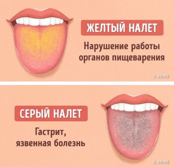 Как выявить проблемы со здоровьем по цвету языка: - 6