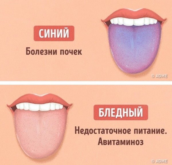Как выявить проблемы со здоровьем по цвету языка: - 3