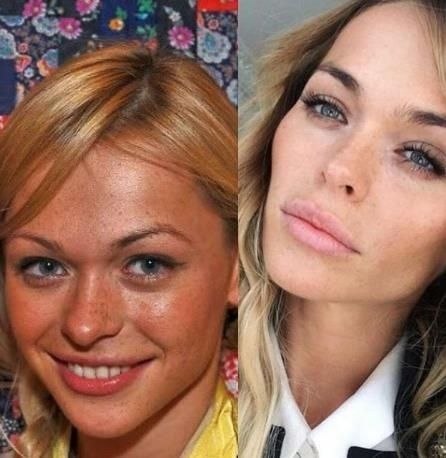 Хилькевич анна до и после операции фото
