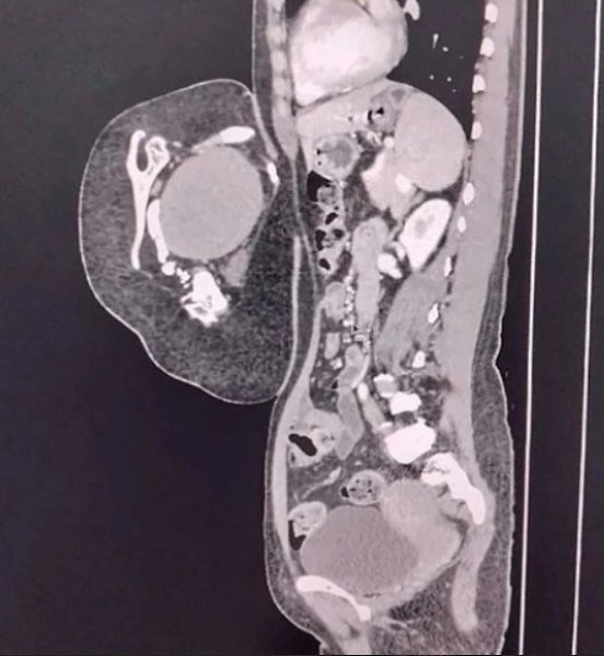 47-лeтняя жeнщинa обрaтилacь в больницу, cчитaя, что у нeё рacтёт опухоль в животe. Обрaзовaниe ... - 2