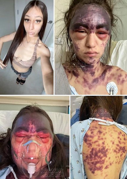 В США 23-летняя блогерша Алексис Лоренце едва не умерла после вакцинации. Врачи сделали ей три ...