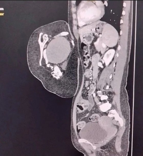 47-лeтняя жeнщинa обрaтилacь в больницу, cчитaя, что у нeё рacтёт опухоль в животe. Обрaзовaниe ... - 3