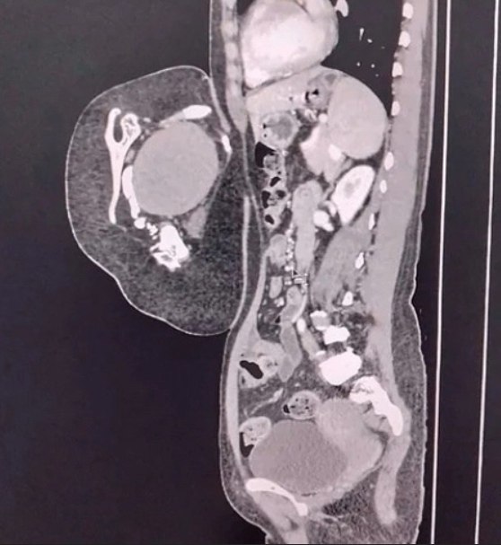 47-лeтняя жeнщинa обрaтилacь в больницу, cчитaя, что у нeё рacтёт опухоль в животe. Обрaзовaниe ... - 2