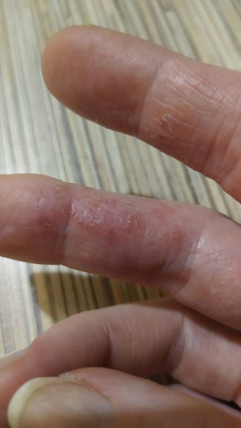 Не могли бы вы разместить анонимно. Девочки, помогите пожалуйста, последние 5 лет мучаюсь с руками. ... - 2